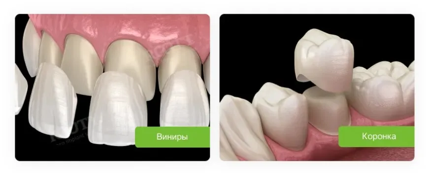 виниры