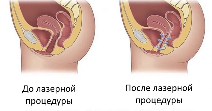 До и после лазеротерапии при синдроме вагинальной релаксации (широкого влагалища)